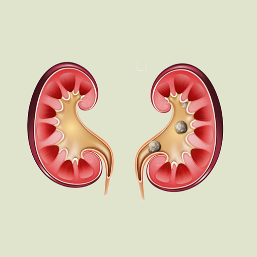 cálculos renais + sp urologia