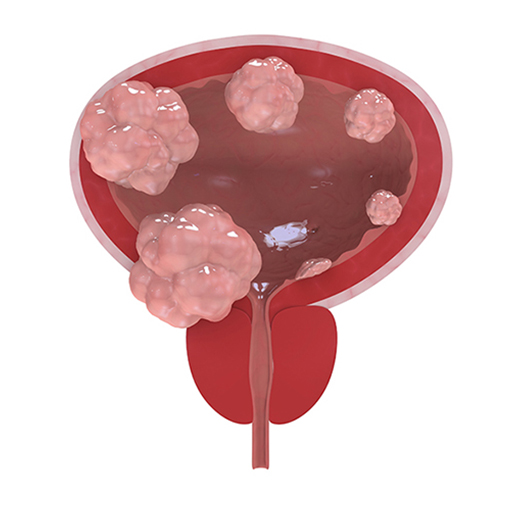 câncer de bexiga + sp urologia