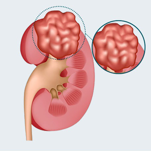 câncer de rim + sp urologia