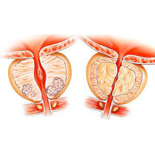 hiperplasia prostática benigna + sp urologia