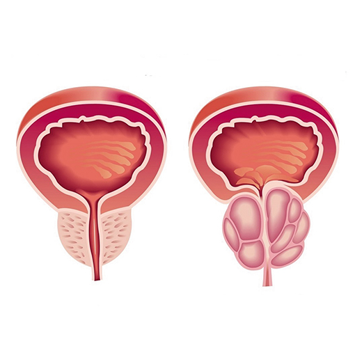 hiperplasia prostática + sp urologia