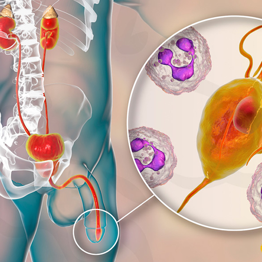 uretrites + sp urologia